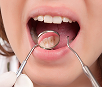  Dental plaque Causes